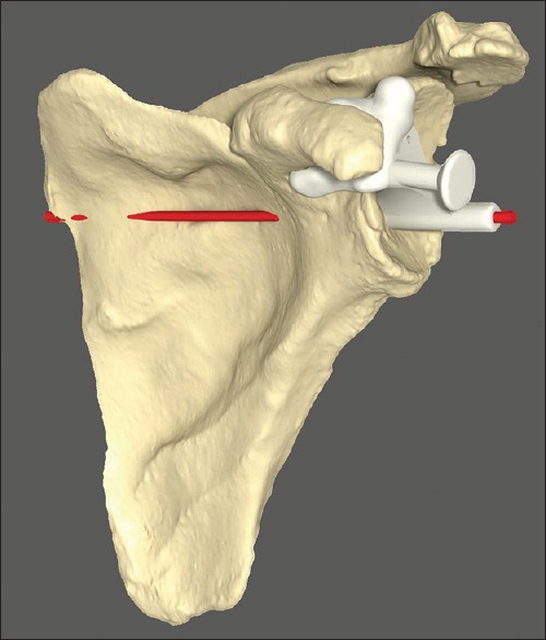 Accuracy of patient-specific instrumentation in anatomic and reverse total shoulder arthroplasty.