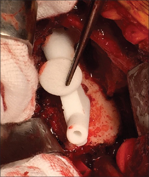 Accuracy of patient-specific instrumentation in anatomic and reverse total shoulder arthroplasty.