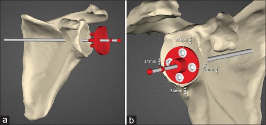 Accuracy of patient-specific instrumentation in anatomic and reverse total shoulder arthroplasty.