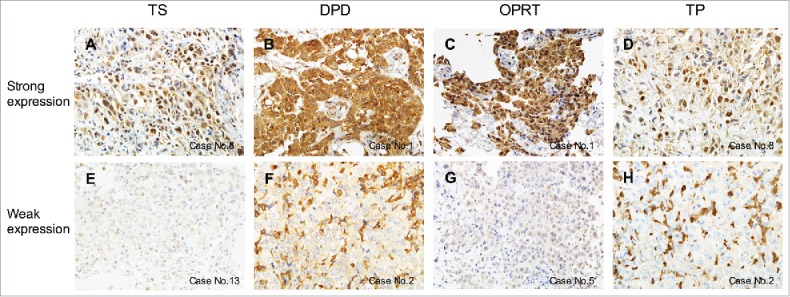 Orotate phosphoribosyltransferase is overexpressed in malignant pleural mesothelioma: Dramatically responds one case in high OPRT expression.