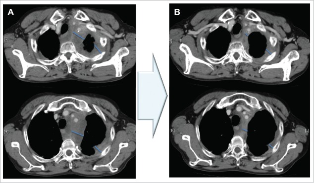 Orotate phosphoribosyltransferase is overexpressed in malignant pleural mesothelioma: Dramatically responds one case in high OPRT expression.