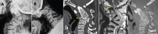 Atlantoaxial dislocation adjacent to kyphotic deformity in a case of adult Larsen syndrome.