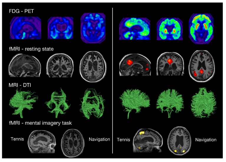 The Role of Neuroimaging Techniques in Establishing Diagnosis, Prognosis and Therapy in Disorders of Consciousness.