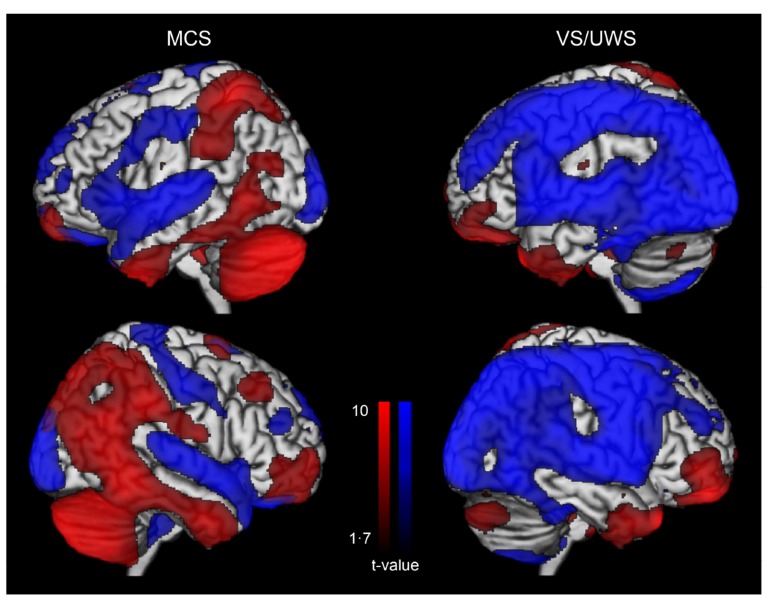 The Role of Neuroimaging Techniques in Establishing Diagnosis, Prognosis and Therapy in Disorders of Consciousness.