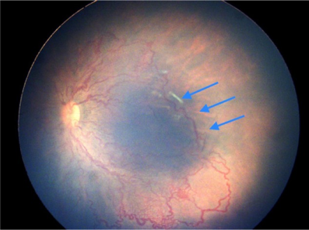 Impact of improved neonatal care on the profile of retinopathy of prematurity in rural neonatal centers in India over a 4-year period.