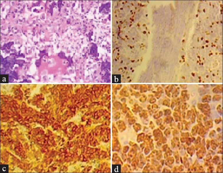 Coexistence of HER2, Ki67, and p53 in Osteosarcoma: A Strong Prognostic Factor.