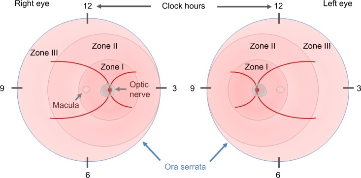 Retinopathy of prematurity: the need for prevention.