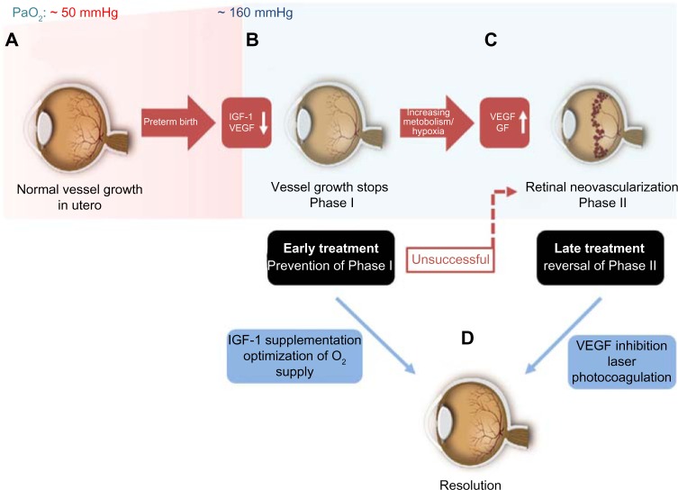 Retinopathy of prematurity: the need for prevention.