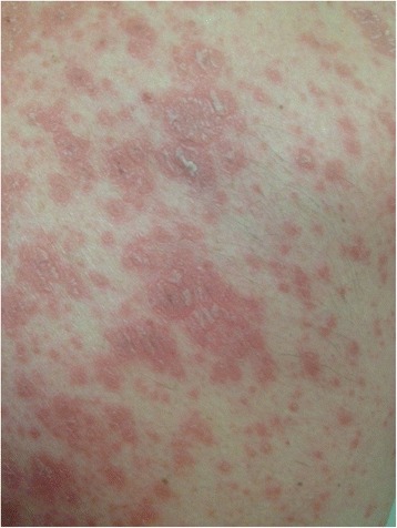 A case of erythrodermia from exacerbated psoriasis vulgaris due to treatment of acute hepatitis C.