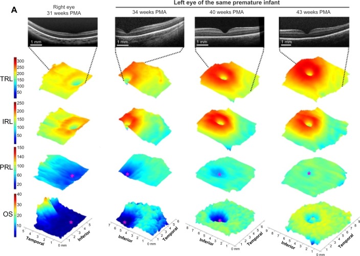 Optical coherence tomography of the preterm eye: from retinopathy of prematurity to brain development.