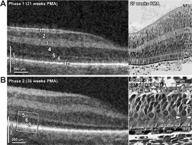 Optical coherence tomography of the preterm eye: from retinopathy of prematurity to brain development.