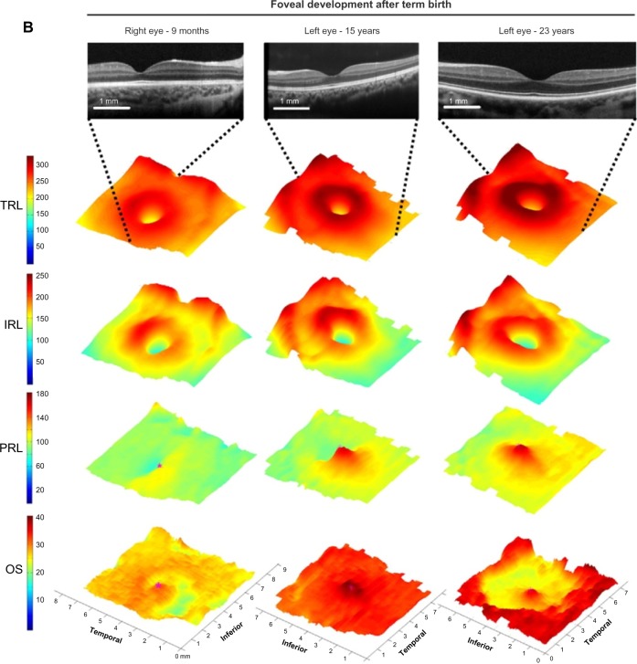 Optical coherence tomography of the preterm eye: from retinopathy of prematurity to brain development.