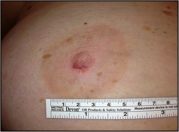 Nipple adenoma in a female patient presenting with persistent erythema of the right nipple skin: case report, review of the literature, clinical implications, and relevancy to health care providers who evaluate and treat patients with dermatologic conditions of the breast skin.