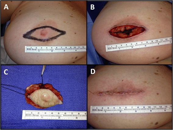 Nipple adenoma in a female patient presenting with persistent erythema of the right nipple skin: case report, review of the literature, clinical implications, and relevancy to health care providers who evaluate and treat patients with dermatologic conditions of the breast skin.