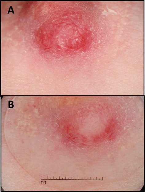 Nipple adenoma in a female patient presenting with persistent erythema of the right nipple skin: case report, review of the literature, clinical implications, and relevancy to health care providers who evaluate and treat patients with dermatologic conditions of the breast skin.