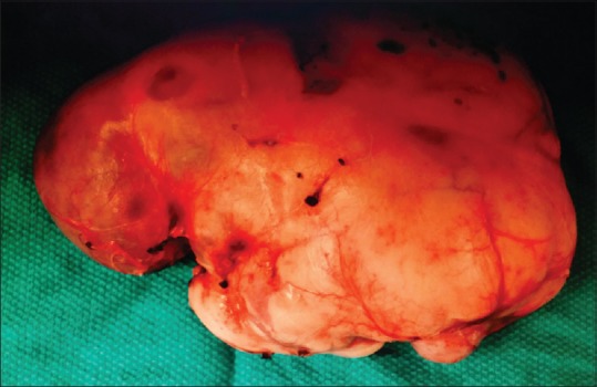 Bi-lobed Perirectal Epidermoid Cyst: An Unusual Cause of Hematochezia in a Middle-aged Woman.