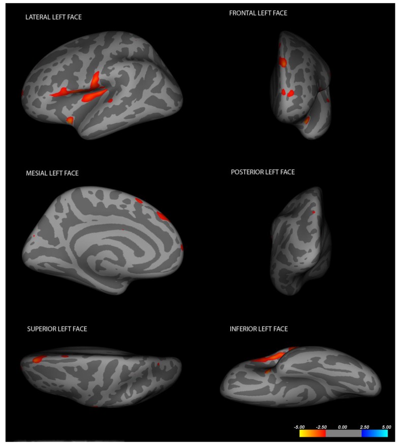 Disembodied Mind: Cortical Changes Following Brainstem Injury in Patients with Locked-in Syndrome.