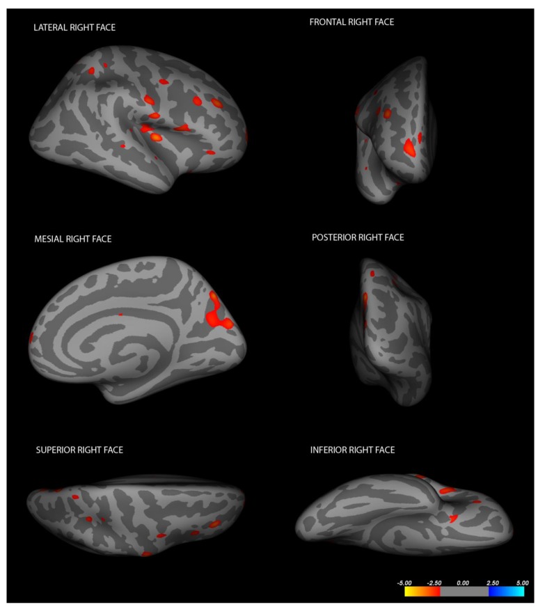 Disembodied Mind: Cortical Changes Following Brainstem Injury in Patients with Locked-in Syndrome.