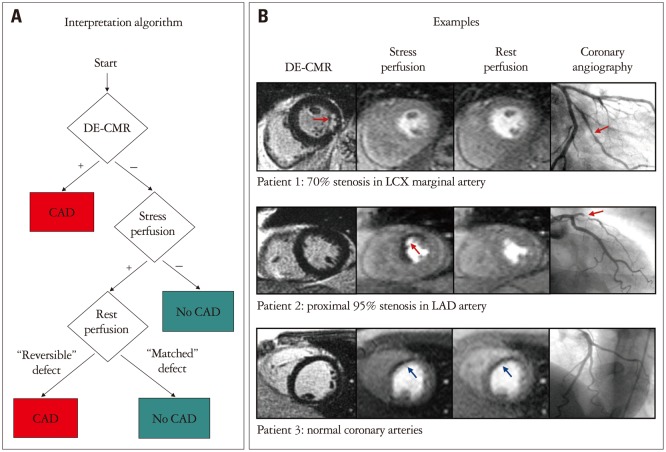 The Use of Cardiac Magnetic Resonance in Patients with Suspected Coronary Artery Disease: A Clinical Practice Perspective.