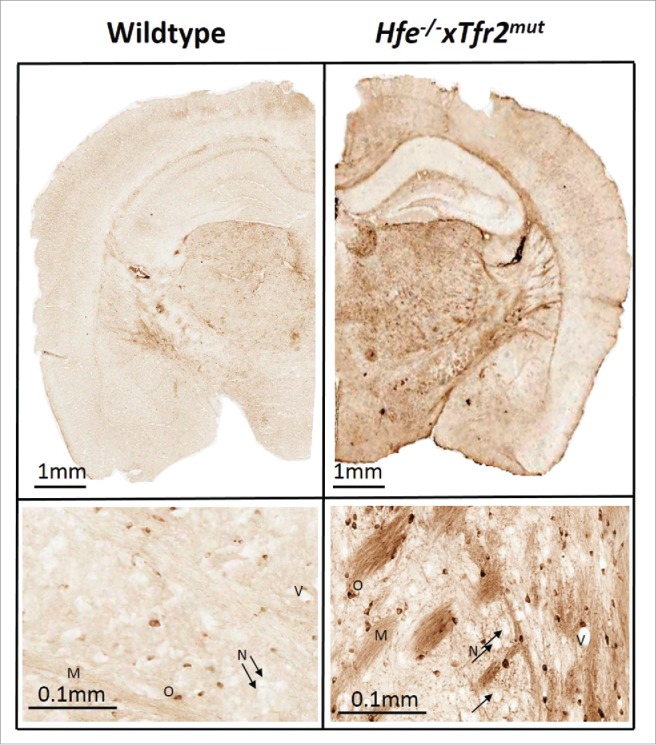 Pathological relationships involving iron and myelin may constitute a shared mechanism linking various rare and common brain diseases.