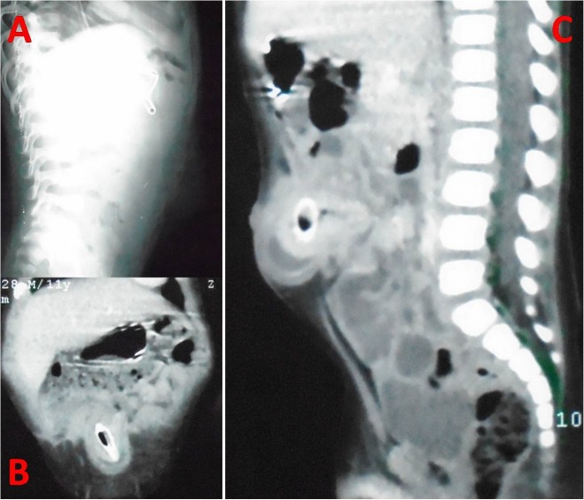 Intestinal Perforation in Obstructed Umbilical Hernia due to Wedged Plum Seed.