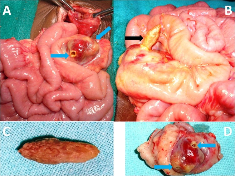 Intestinal Perforation in Obstructed Umbilical Hernia due to Wedged Plum Seed.