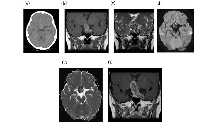 Primary Intracranial Choriocarcinoma Located in the Suprasellar Region.