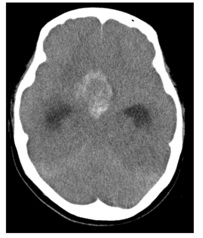 Primary Intracranial Choriocarcinoma Located in the Suprasellar Region.