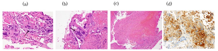 Primary Intracranial Choriocarcinoma Located in the Suprasellar Region.