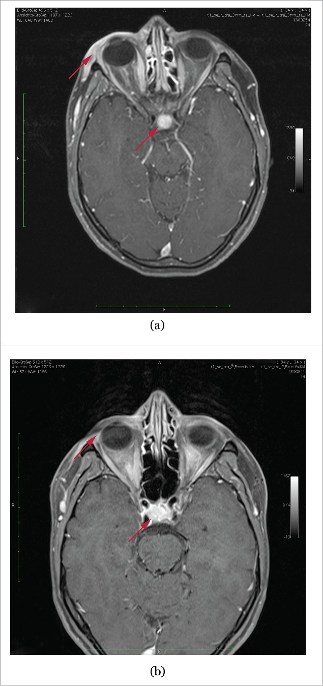 Sneaky side effects and ineffectiveness of an immunotherapy with ipilimumab in a case of metastatic melanoma.