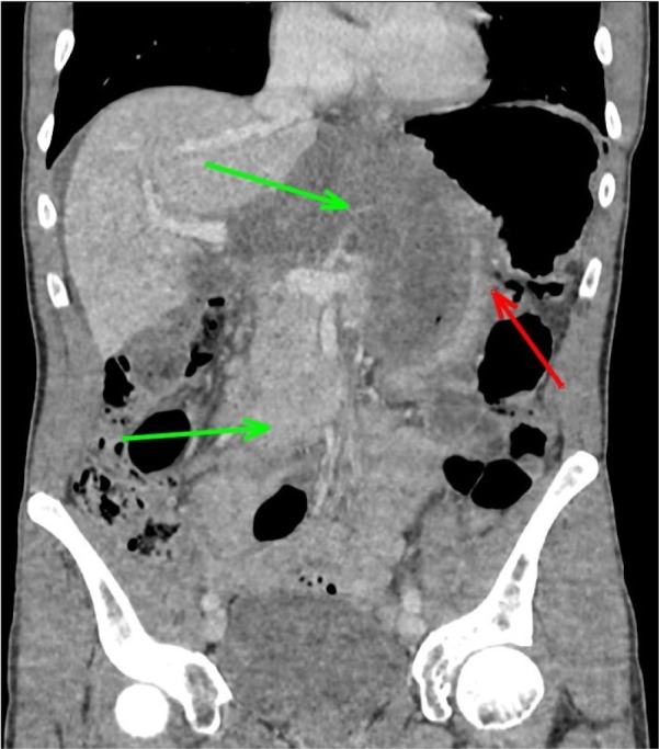 Internal Herniation Through Foramen of Winslow: A Diagnosis Not to Be Missed.