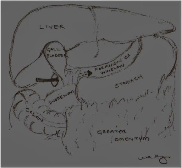 Internal Herniation Through Foramen of Winslow: A Diagnosis Not to Be Missed.