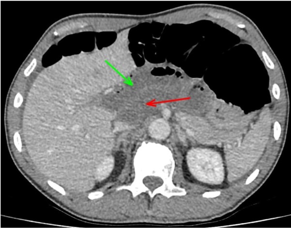 Internal Herniation Through Foramen of Winslow: A Diagnosis Not to Be Missed.