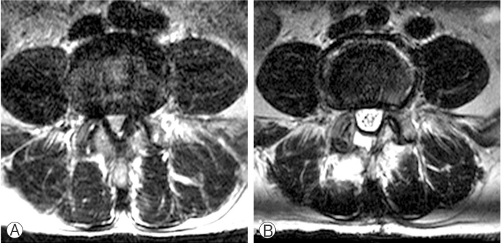 Clinical and Radiological Comparison between Ipsilateral and Contralateral Side Canal Decompression Using an Unilateral Laminotomy Approach.