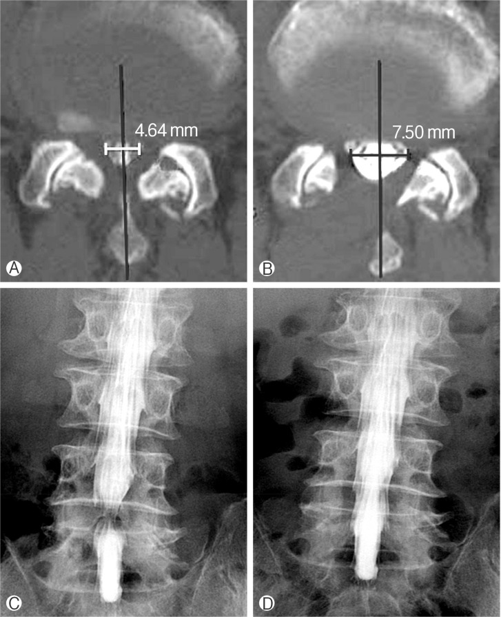 Clinical and Radiological Comparison between Ipsilateral and Contralateral Side Canal Decompression Using an Unilateral Laminotomy Approach.