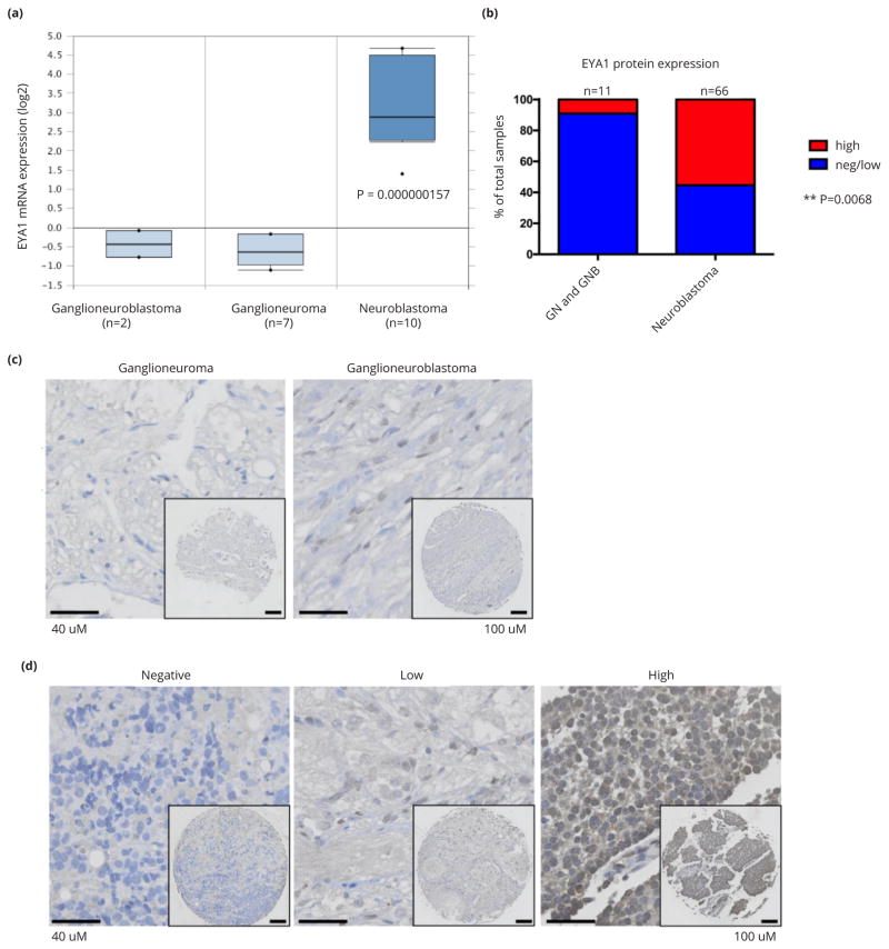 EYA1 expression and subcellular localization in neuroblastoma and its association with prognostic markers.