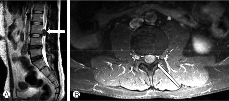 Diffuse Large B-Cell Lymphoma Mimicking Schwannoma of Lumbar Spine.