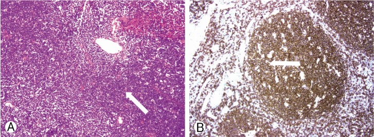 Diffuse Large B-Cell Lymphoma Mimicking Schwannoma of Lumbar Spine.