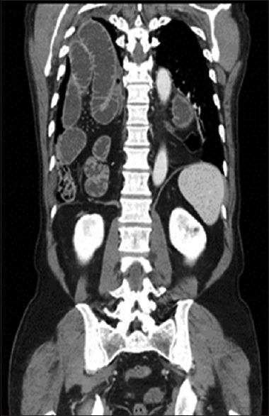 Acute Bowel Obstruction in a Giant Recurrent Right Bochdalek's Hernia: A Report of Complication on Both Sides of the Diaphragm.