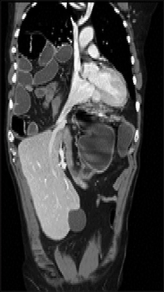 Acute Bowel Obstruction in a Giant Recurrent Right Bochdalek's Hernia: A Report of Complication on Both Sides of the Diaphragm.