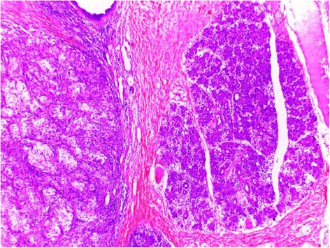 Parotid gland, an exceptional localization of sebaceous carcinoma: case report.