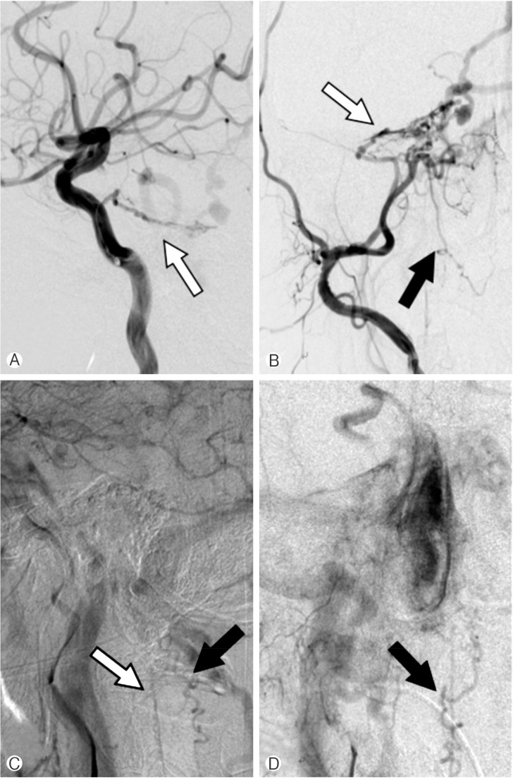 Cervical Myelopathy Caused by Intracranial Dural Arteriovenous Fistula.