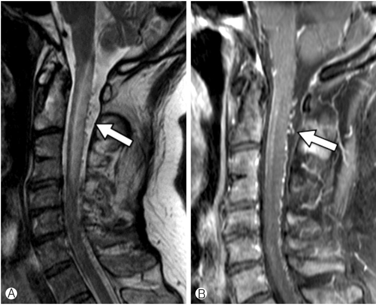 Cervical Myelopathy Caused by Intracranial Dural Arteriovenous Fistula.