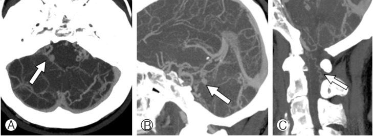 Cervical Myelopathy Caused by Intracranial Dural Arteriovenous Fistula.