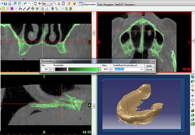 Assessing the Effect of Dental Implants Thread Design on Distribution of Stress in Impact Loadings Using Three Dimensional Finite Element Method.