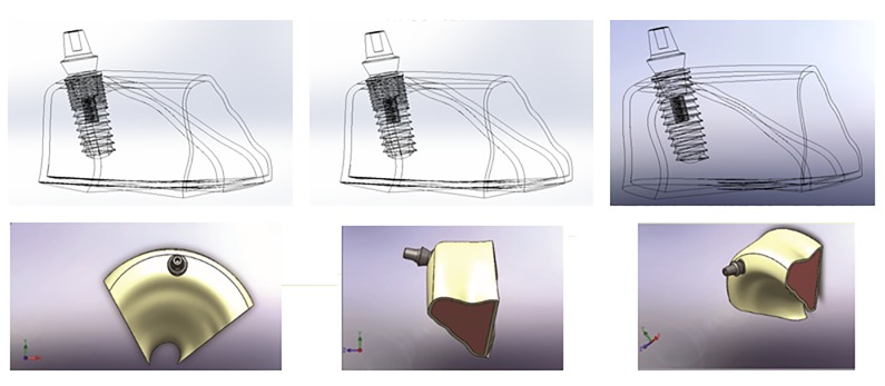 Assessing the Effect of Dental Implants Thread Design on Distribution of Stress in Impact Loadings Using Three Dimensional Finite Element Method.