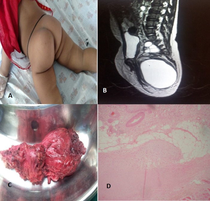 Sacrococcygeal Teratoma: Mistreated With Repeated Aspirations.