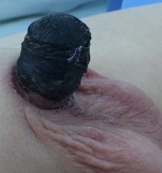 Skin and Neourethral Necrosis in Staged Hypospadias Repair.