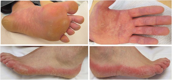 The first Danish family reported with an AQP5 mutation presenting diffuse non-epidermolytic palmoplantar keratoderma of Bothnian type, hyperhidrosis and frequent Corynebacterium infections: a case report.