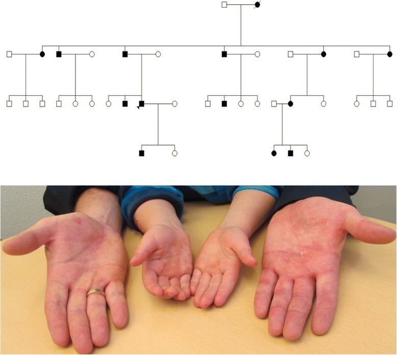 The first Danish family reported with an AQP5 mutation presenting diffuse non-epidermolytic palmoplantar keratoderma of Bothnian type, hyperhidrosis and frequent Corynebacterium infections: a case report.